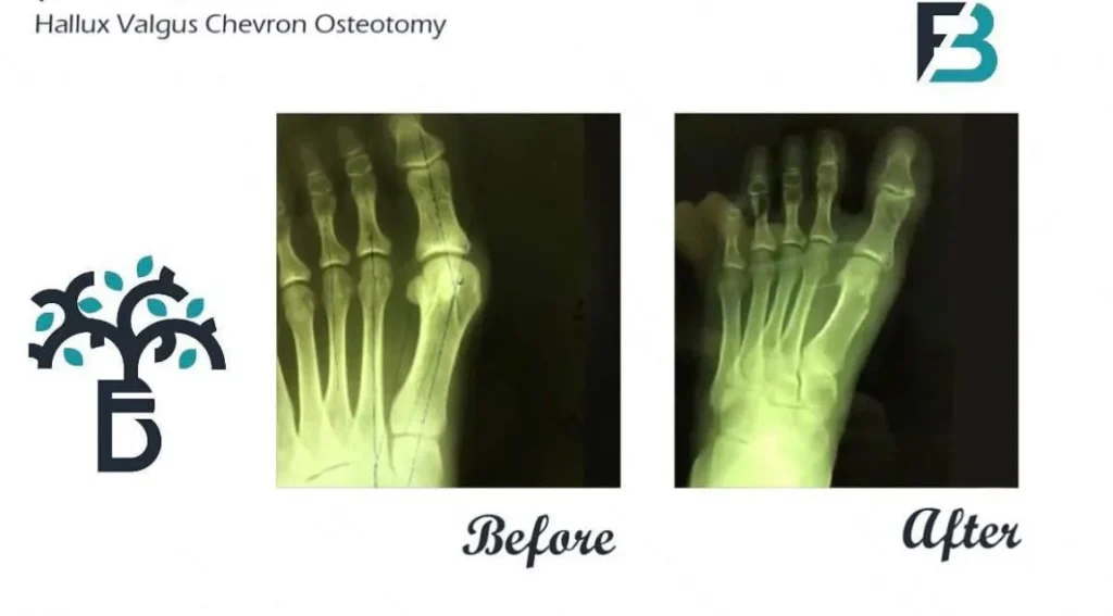 bunion (hallux valgus) before and after surgery by Dr farivar bagheri