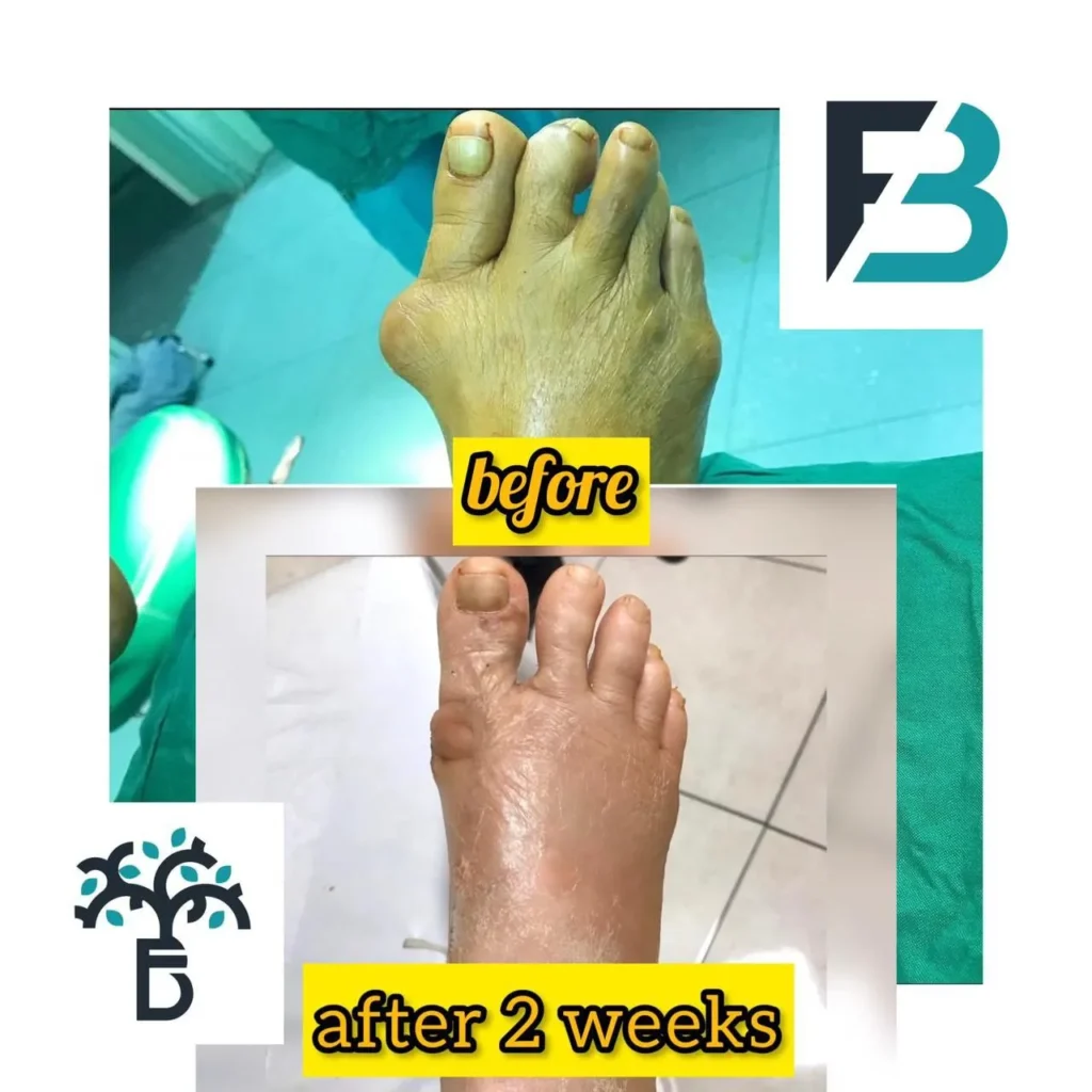 Hallux valgus surgery by Dr Farivar Bagheri - Before and After
