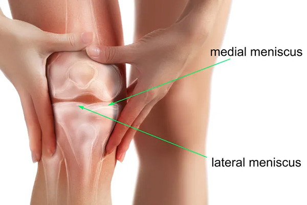 common symptoms of a torn meniscus