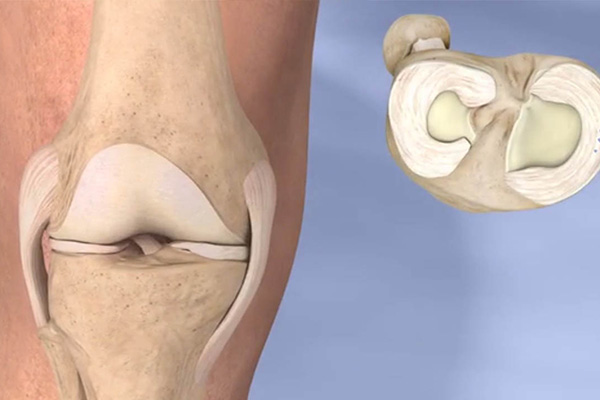 diagnosing meniscus tear injuries
