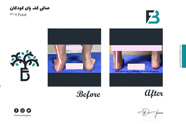 how to fix flat feet