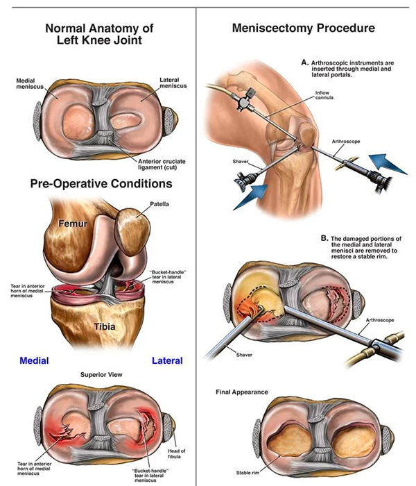 meniscus treatment options in dubai