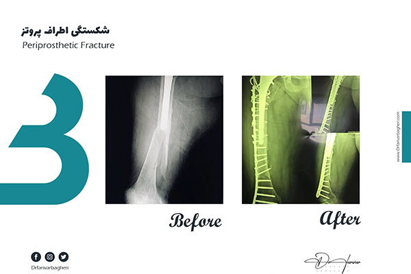nonunion bone fracture