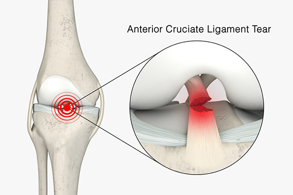 Anterior,Cruciate,Ligament,Tear,3d,Rendering,,Acl,Tear,,Acl,Injury,