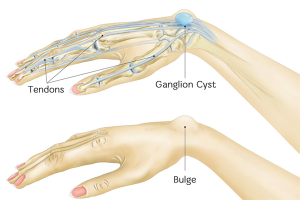 symptoms of ganglion