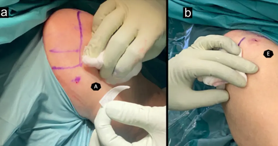 Advanced Options for Biceps Tendon Treatment