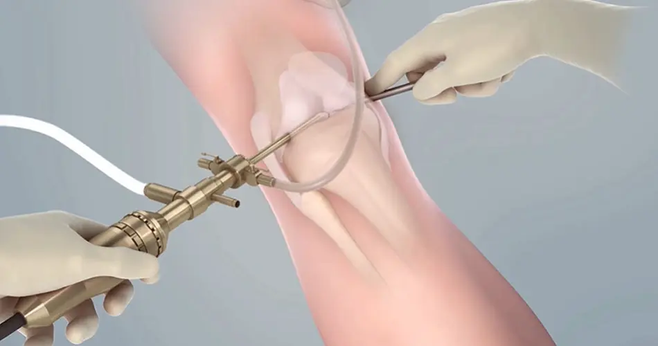 Advanced Options for Knee Surgery and Arthroscopy