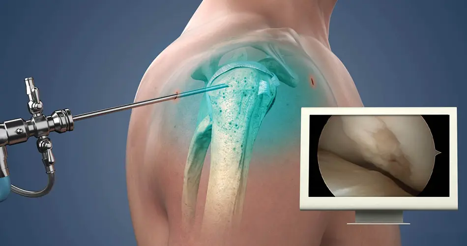 Advanced Options for Shoulder Surgery in Dubai