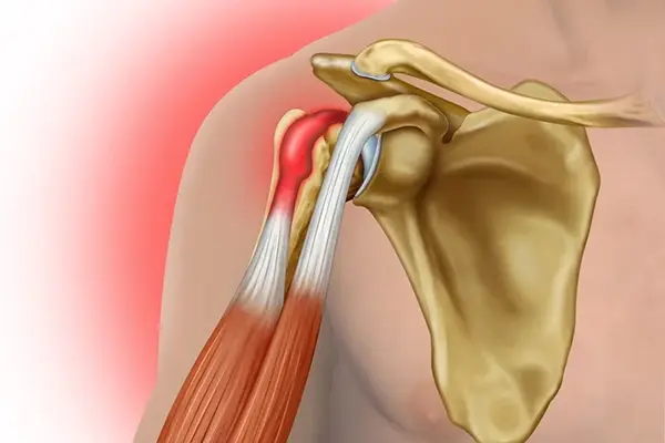 Key Highlights of Biceps Pathologies Treatment