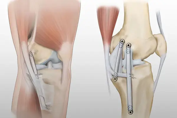 Key Highlights of Collateral Ligament Surgery