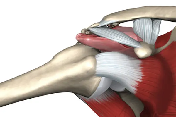 Key Highlights of Impingement Syndrome Management