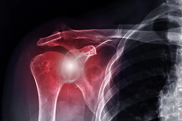 Key Highlights of Shoulder Instability (Bankart / SLAP Repair)
