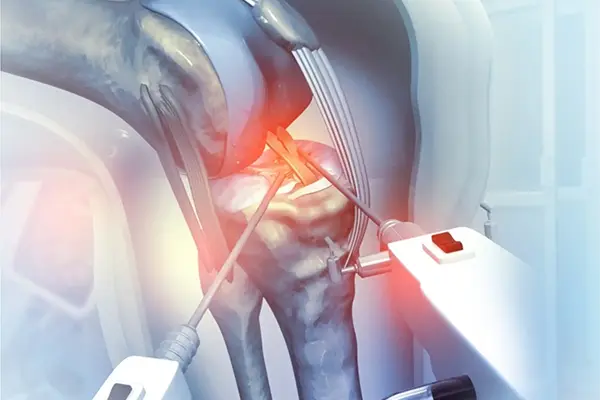 Key Highlights of Total Knee Arthroplasty (TKA)