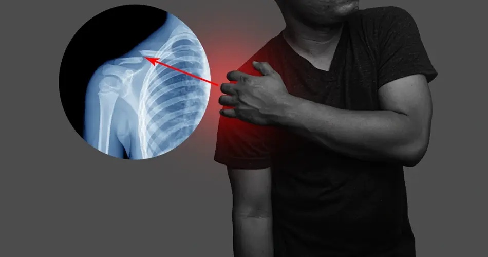 Why Consider Bankart / SLAP Repair in Dubai?