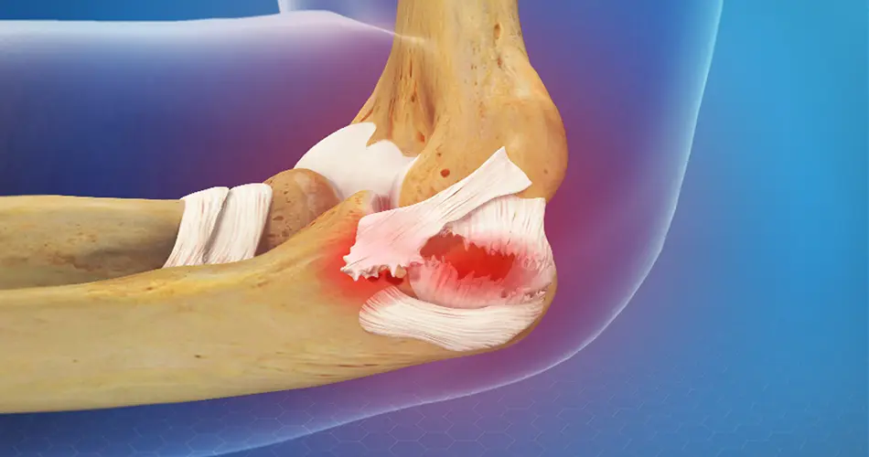 Why Consider Collateral Ligament Surgery in Dubai?