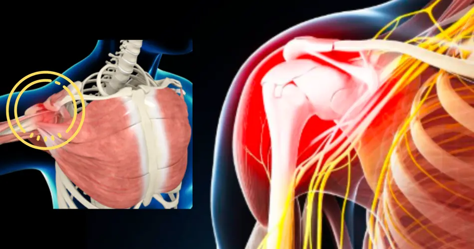 Why Consider Impingement Syndrome Treatment in Dubai?