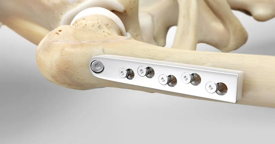 Advanced Options for Hip Fracture Fixation