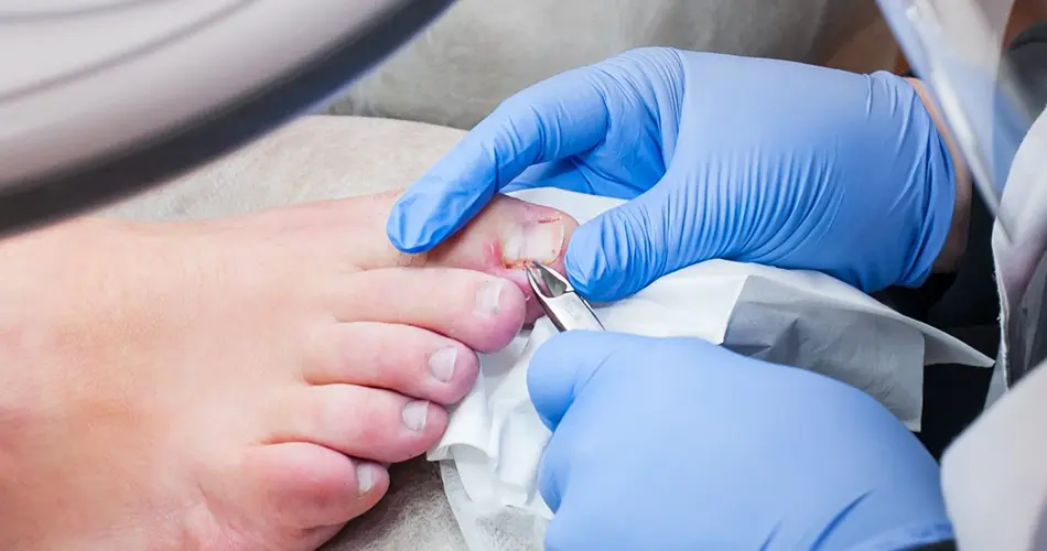Advanced Options for Ingrown Toenail Removal