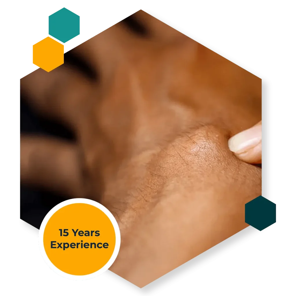 ganglion cyst is a fluid-filled