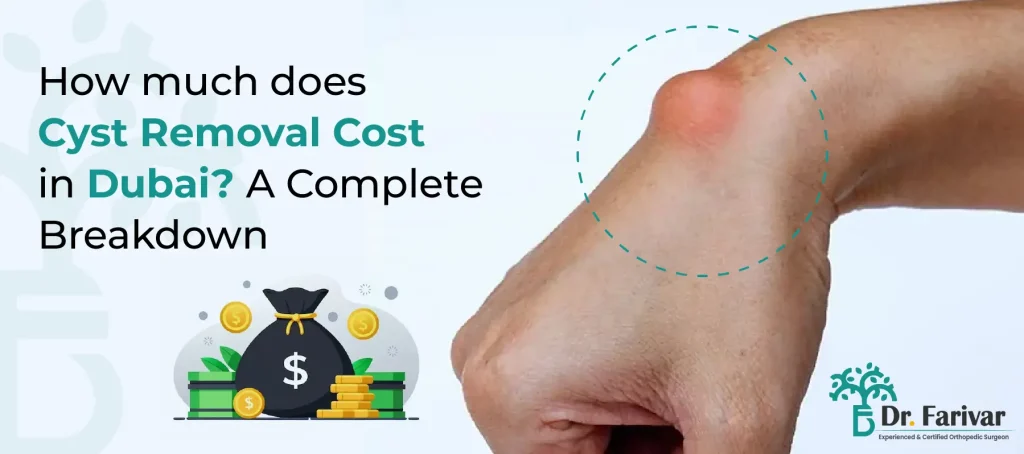 how much does cyst removal