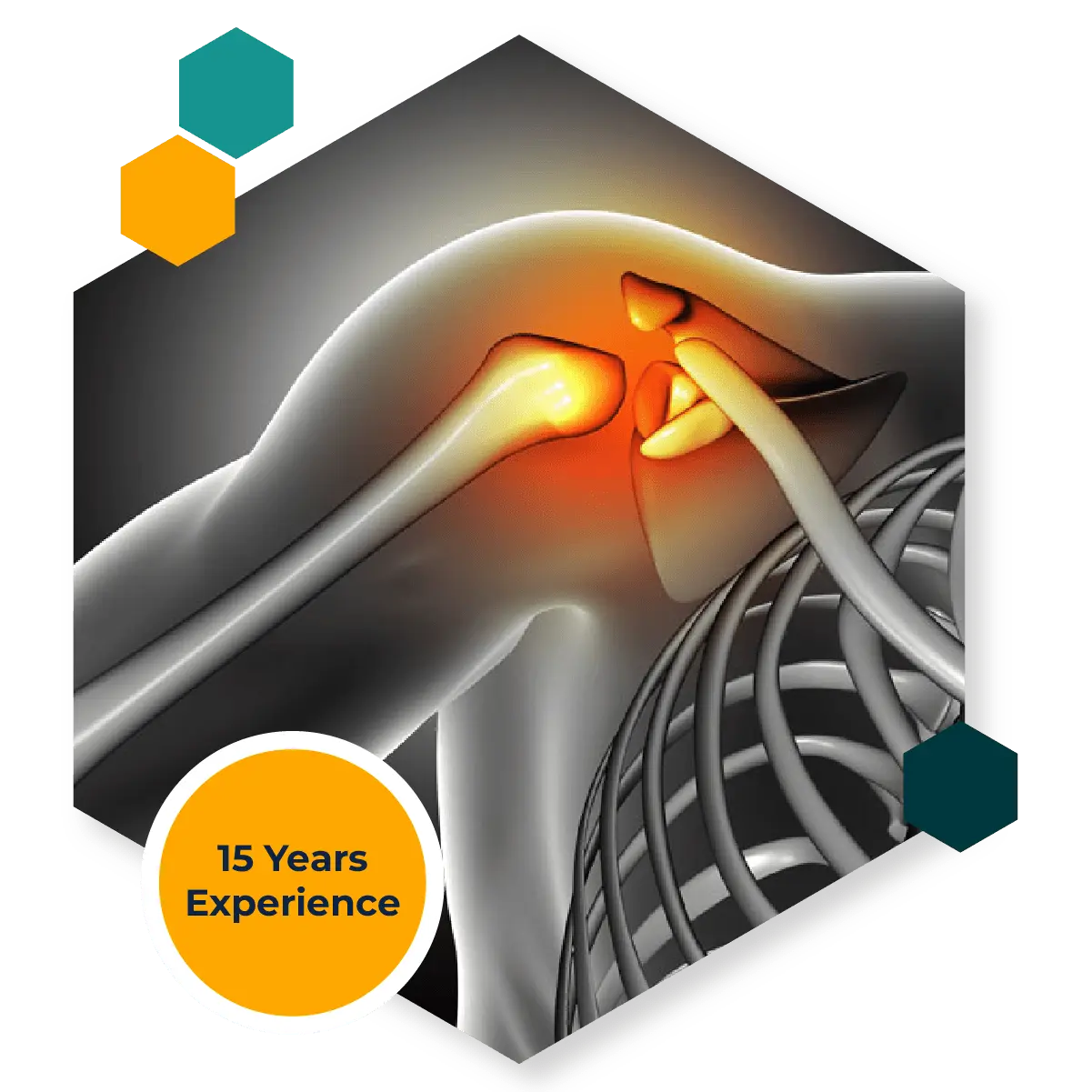 Shoulder impingement syndrome