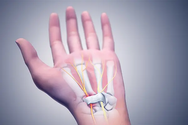 Key Highlights of Carpal Tunnel Surgery