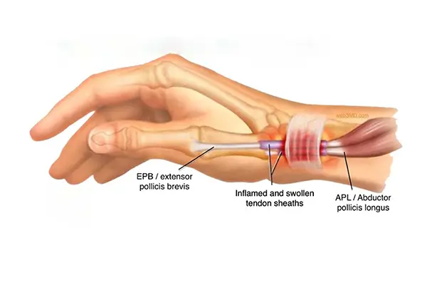 Key Highlights of De Quervain’s Injection