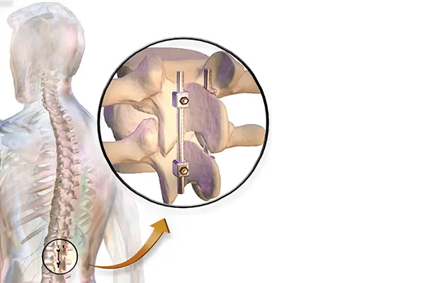 Key Highlights of Degenerative Disc Treatment