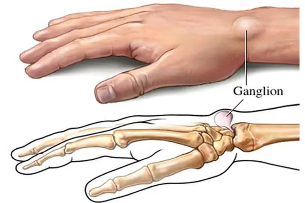 Key Highlights of Ganglion Cyst Removal
