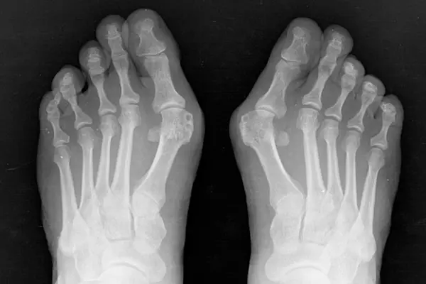 Key Highlights of Hallux Valgus (Bunion Surgery)