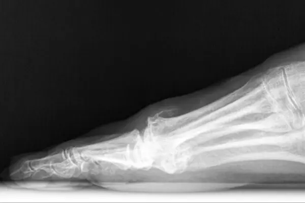 Key Highlights of Hallux Rigidus Treatment