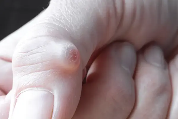 Key Highlights of Hand Cyst Surgery