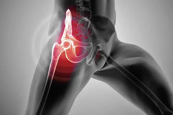 Key Highlights of Hip Dysplasia & Impingement Treatment