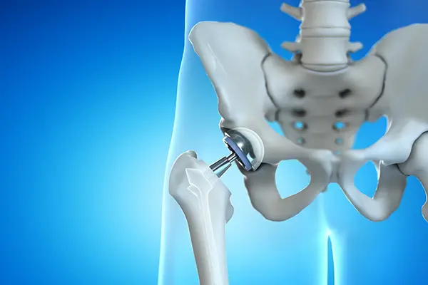 Key Highlights of Minimally Invasive Hip Surgery
