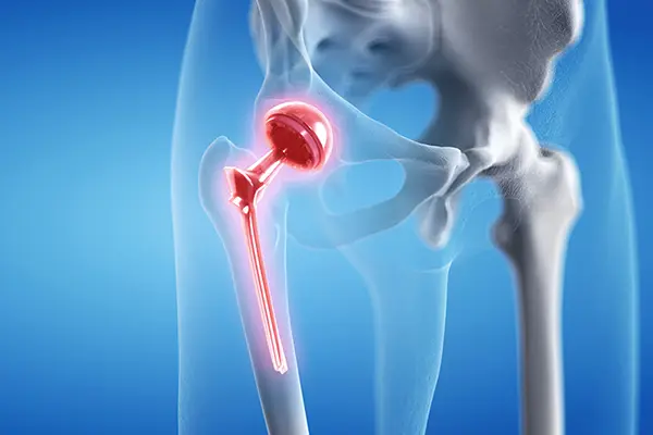 Key Highlights of Revision Hip Replacement