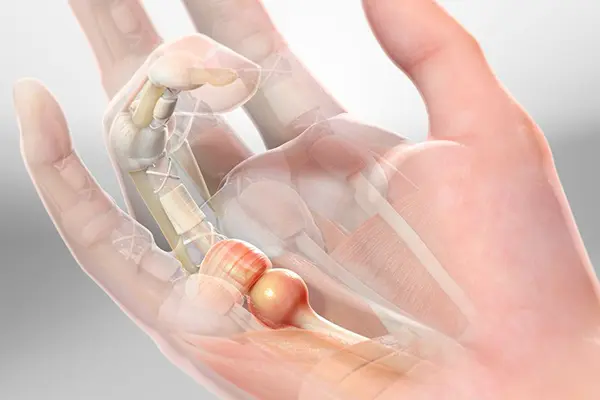 Key Highlights of Trigger Finger Release