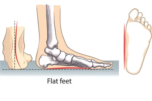 Key Highlights of Flat Feet Correction