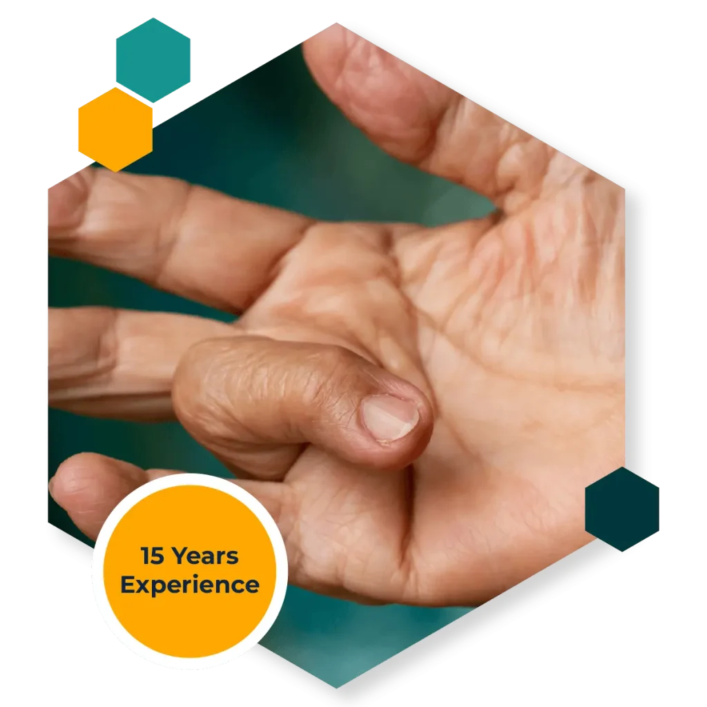 Trigger Finger (Stenosing Tenosynovitis)