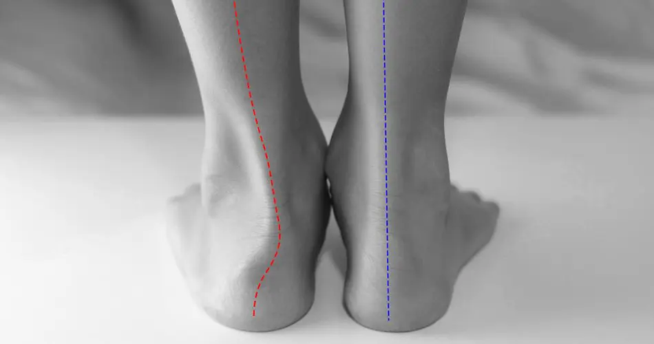 Why Consider Flat Feet Treatment in Dubai?