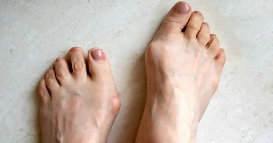 Why Consider Hallux Rigidus Surgery in Dubai?