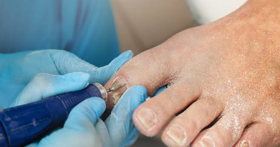 Why Consider Ingrown Toenail Surgery in Dubai?