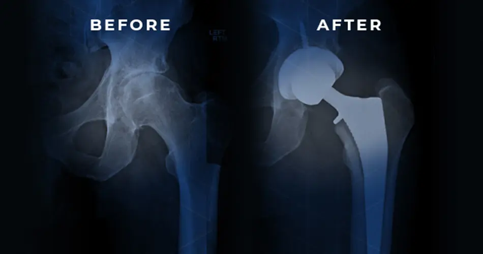 Why Consider Minimally Invasive Hip Surgery in Dubai?