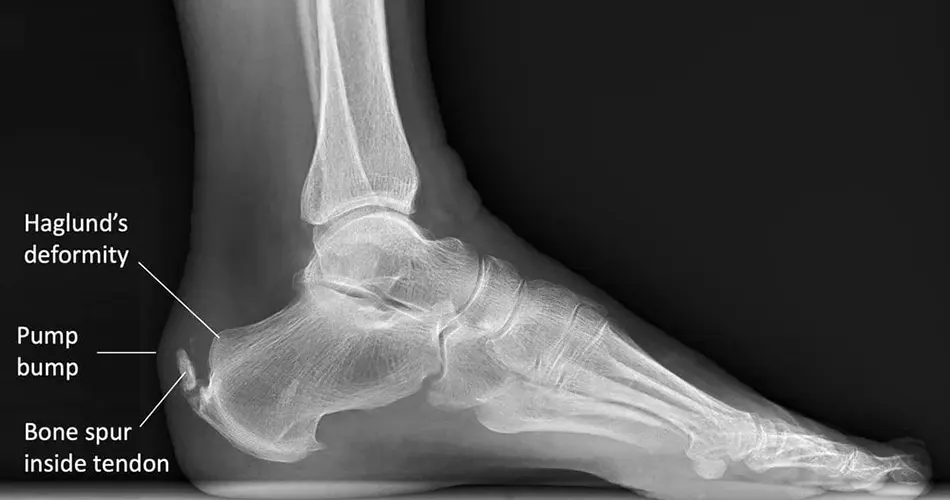 Why Consider PRP for Achilles Tendinitis in Dubai?