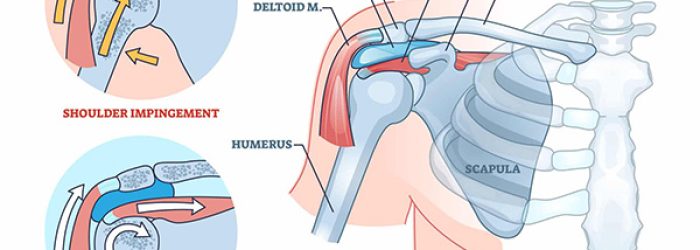 Shoulder impingement syndrome from rubbing rotator cuff outline diagram Shoulder impingement syndrome from rubbing rotator cuff outline diagram