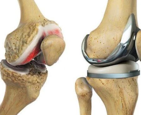 what is total knee what is total knee